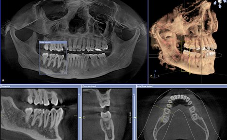 CBCT